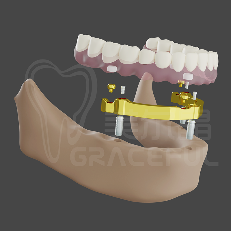 5 hvězdiček Dentallmplant