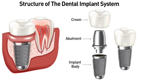 Implants dentals