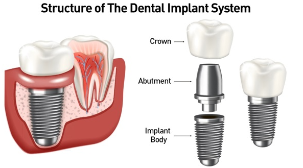 Implants nify