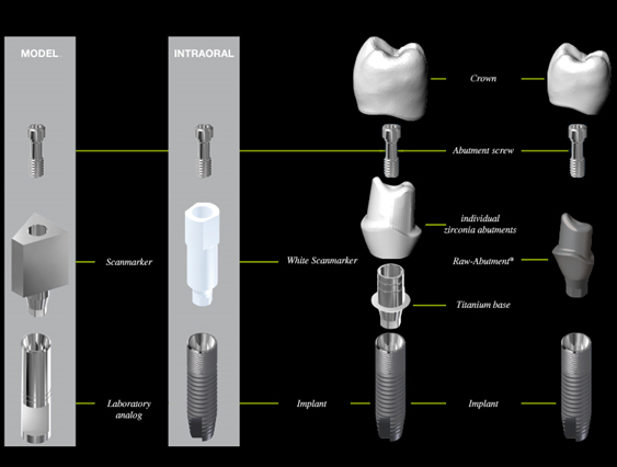 Implantat (12)