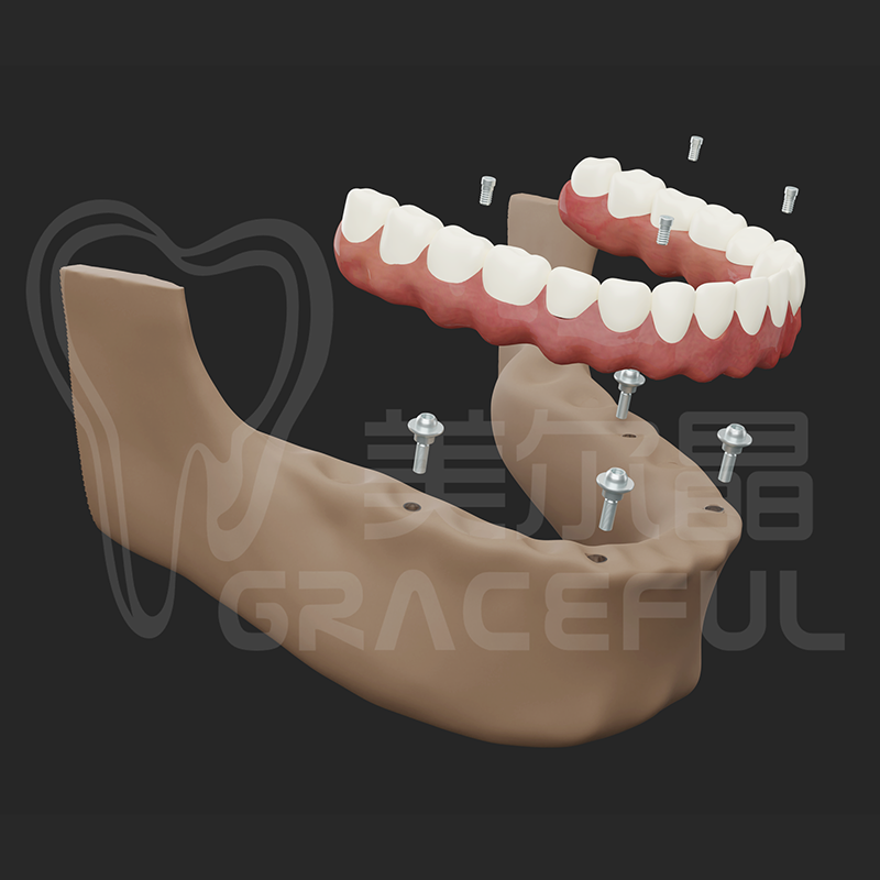 Titanium Framework+Lavers Teeth