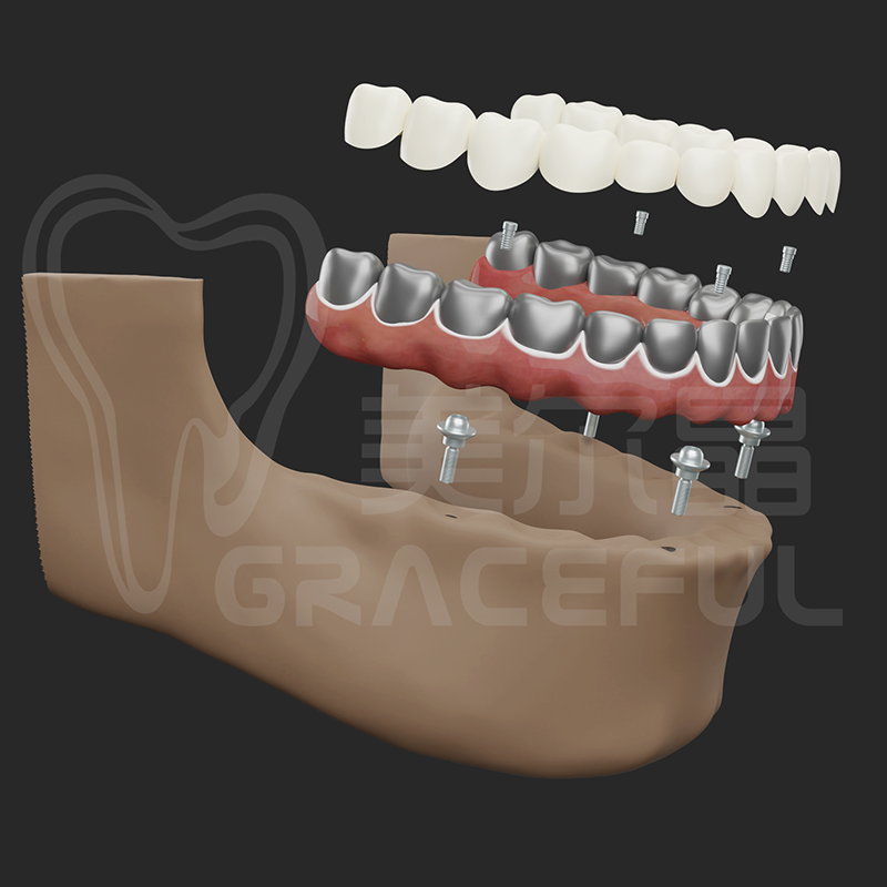 Cadru de titan + coroana din zirconiu